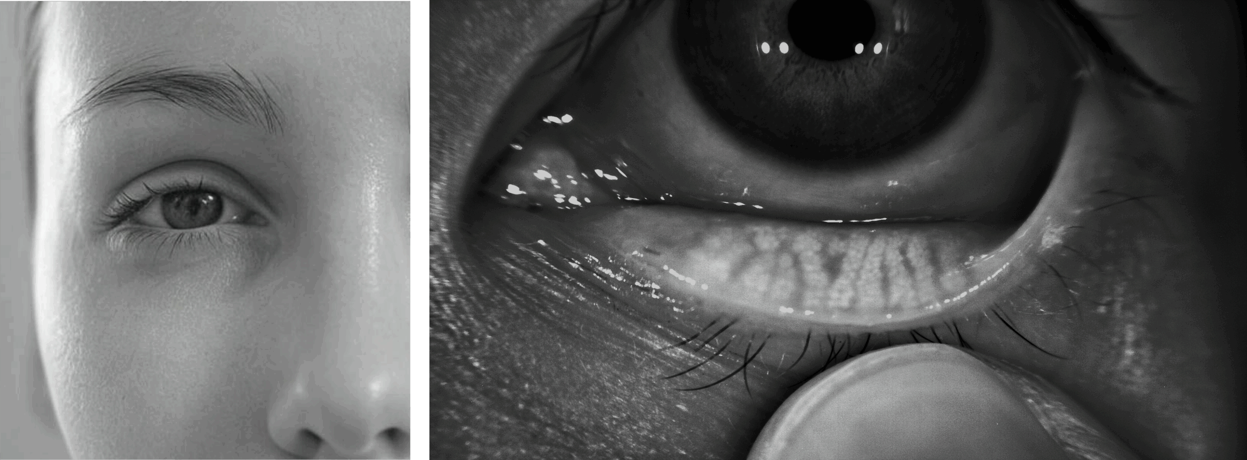 Miopía patológica: Tipos de miopía