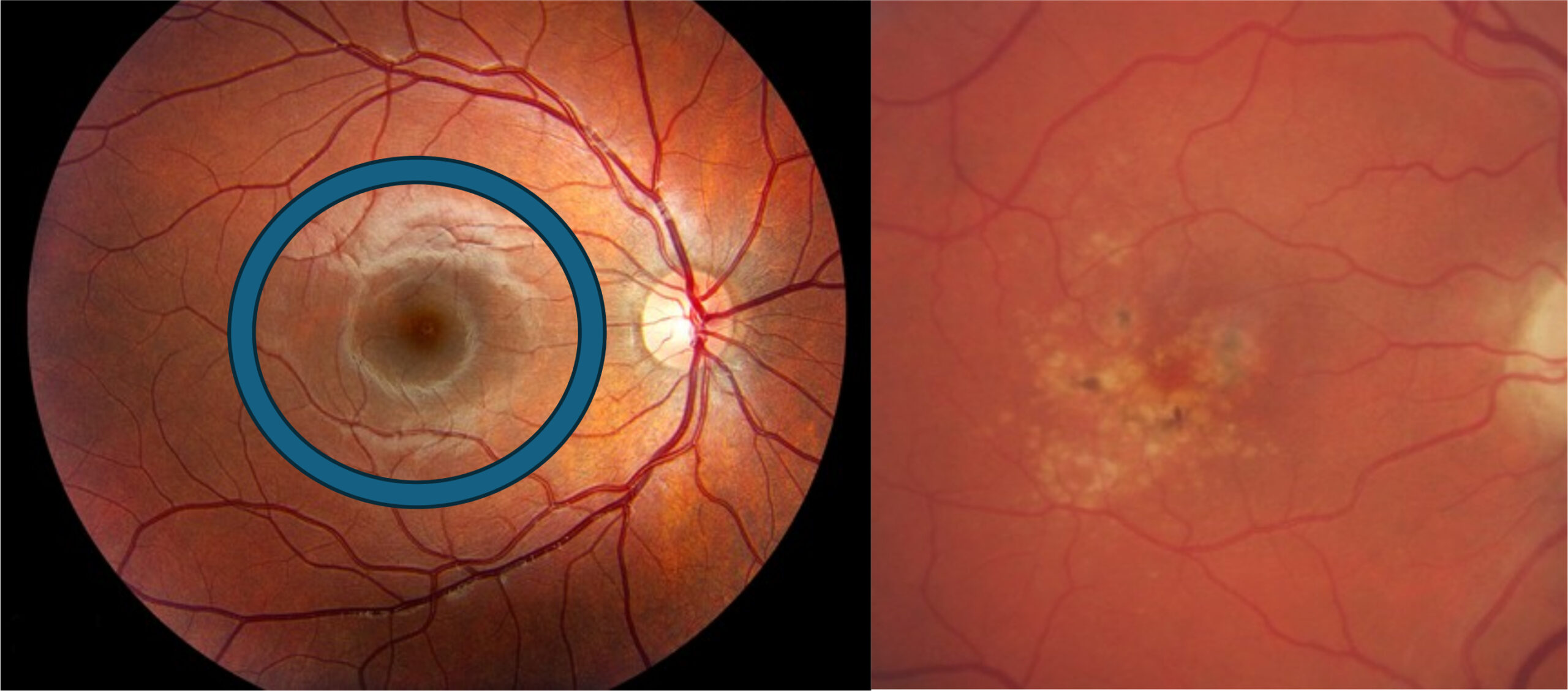 Imagen de una mácula afectada por la DMAE.