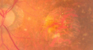 DMAE-AA Miopía patológica: Tipos de miopía