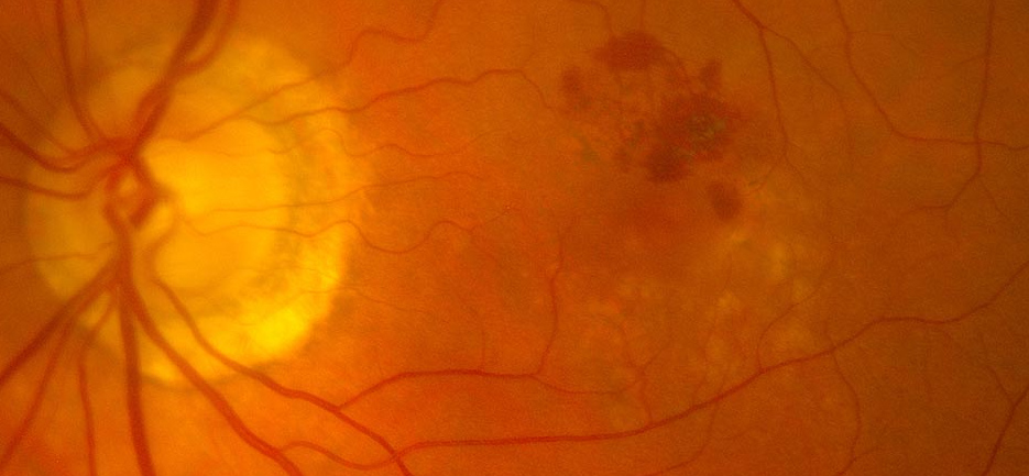 DMAE-AN Miopía patológica: Tipos de miopía