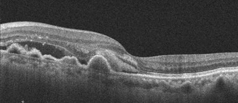 DMAE-OCTM Miopía patológica: Tipos de miopía