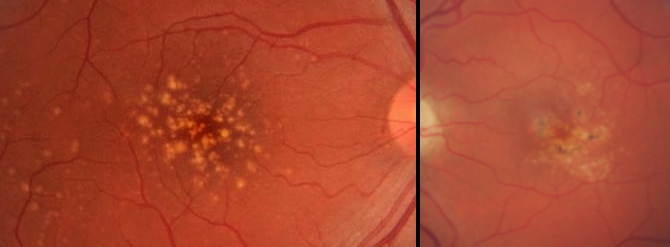 DMAE-intermedia Miopía patológica: Tipos de miopía
