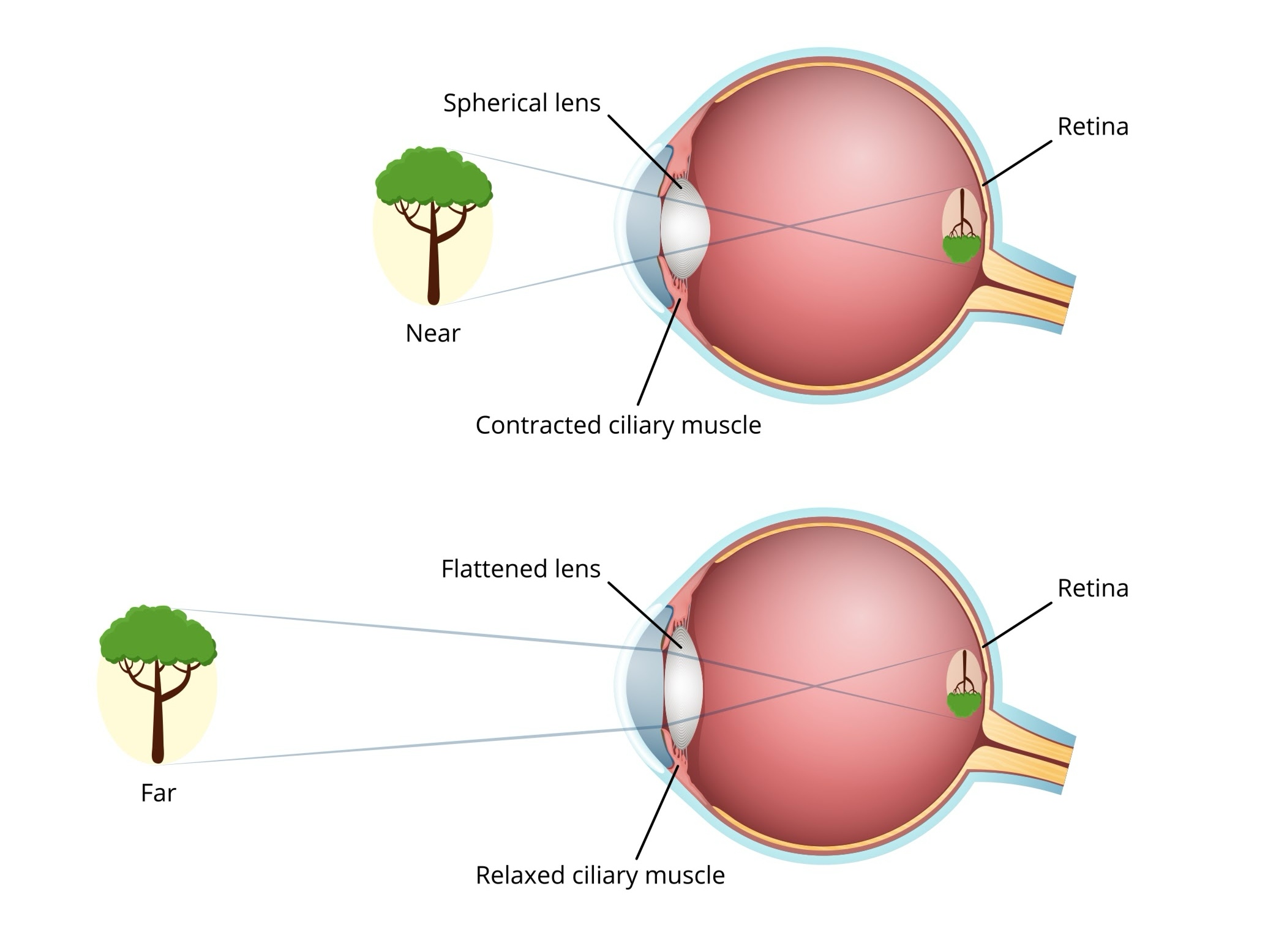 Miopía patológica: Tipos de miopía